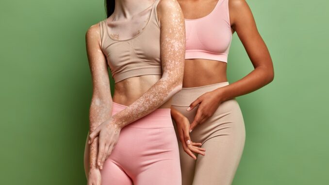 Two interracial women with different skin condition pose against vivid green background. Female affected by vitiligo. Women lingerie advertisement Pigmentové skvrny: jak vznikají a co s nimi dělat